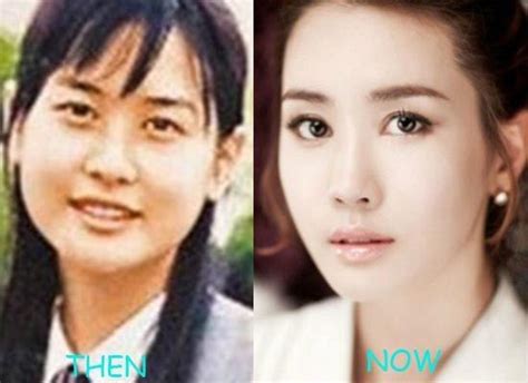 Korean Actors Actresses Before And After Plastic Surgery