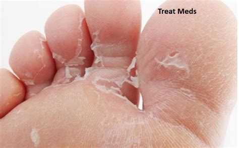 skin peeling between toes causes symptoms pictures and natural
