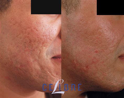 acne scar removal    pictures  actual patients