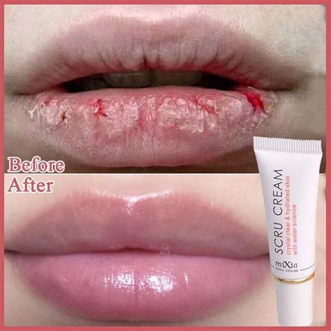 What To Do With Dead Skin On Lips