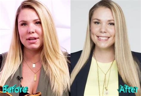 kailyn lowry plastic surgery not shy about it at all