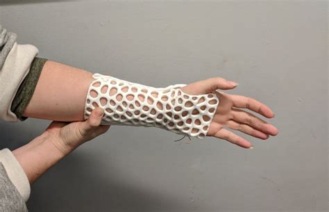 design custom  printable braces  arm injury  steps