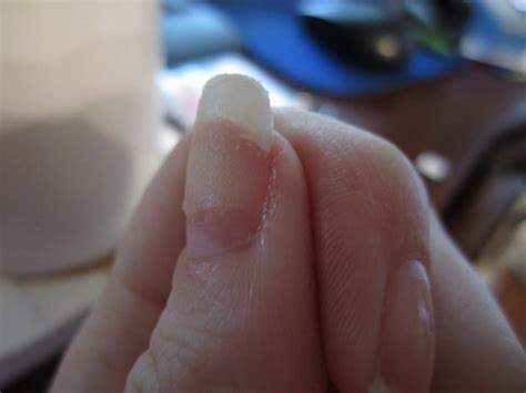 polished medic broken nail