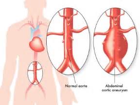 aneurysma formen ursachen symptome diagnose drstephans