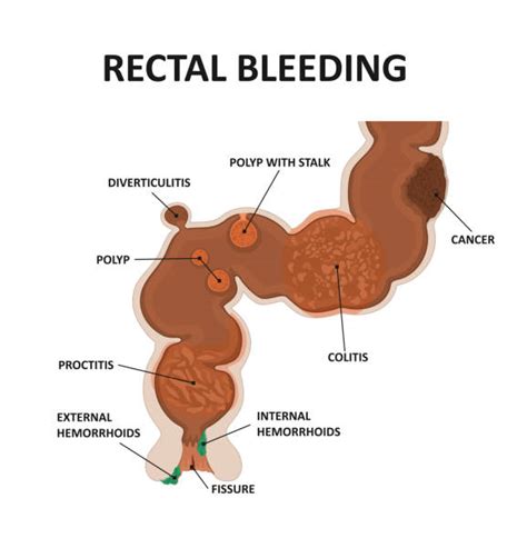 30 rectal diagram pics illustrations royalty free vector graphics