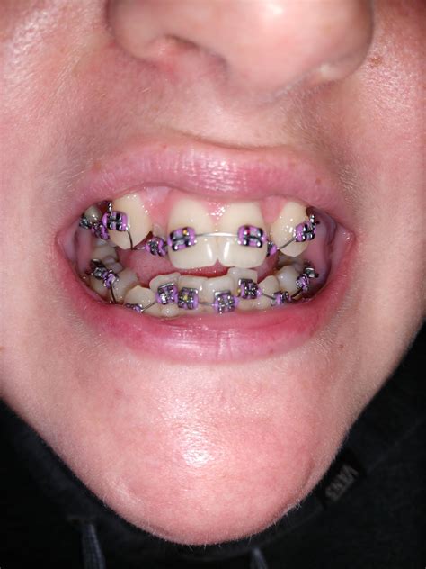 braces    full day  braces  days    teeth