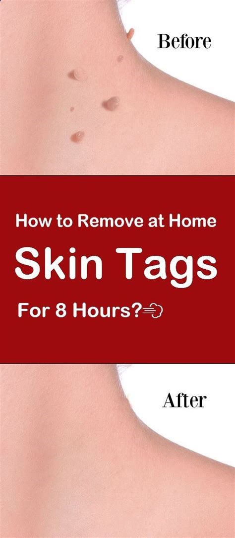 easy ways to remove skin tags naturally at home health