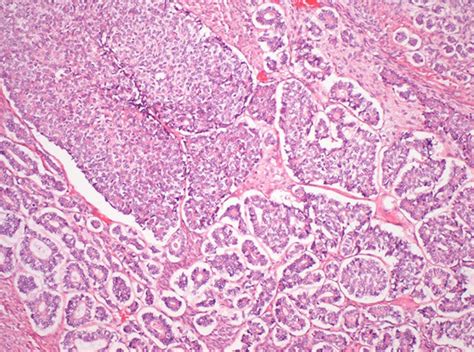 carcinosarcoma of the uterine cervix a rare pathological finding
