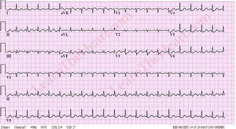 Atrial Flutter With 2 1 Conduction Ecg Example 1 Learn The Heart