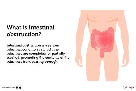 long     partial bowel obstruction insights  outlook