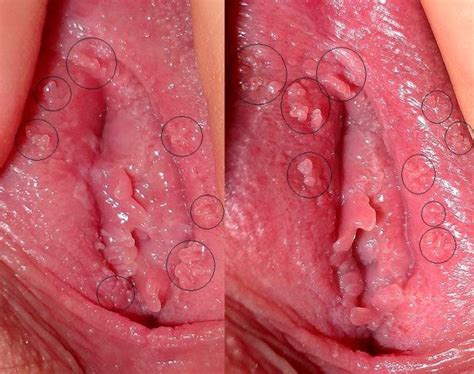 vagina herpes picture excelent porn