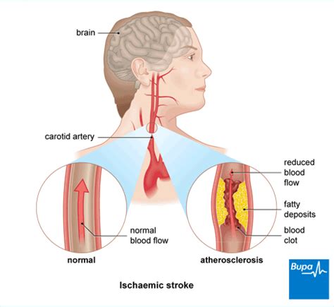 How to find the right sex stroke
