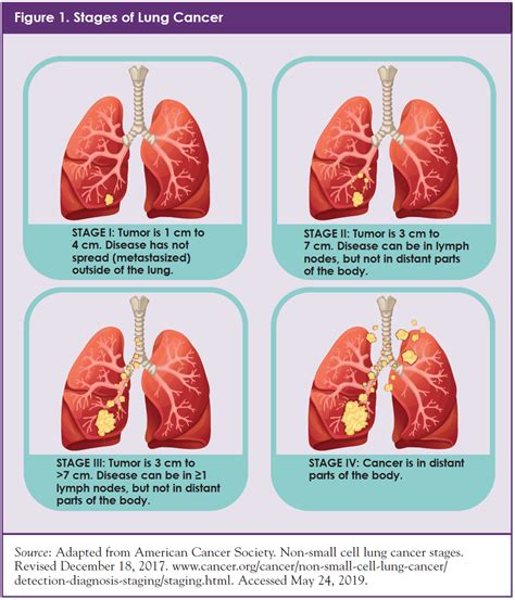 lung cancer staging diagram