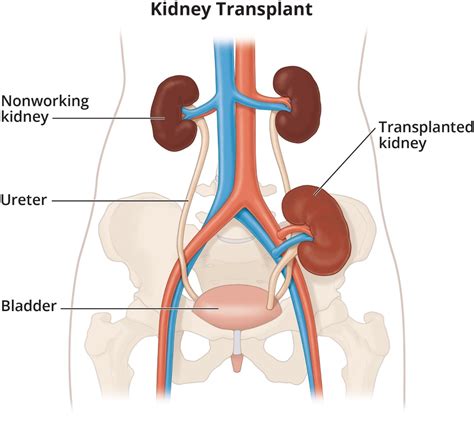 kidney transplant niddk