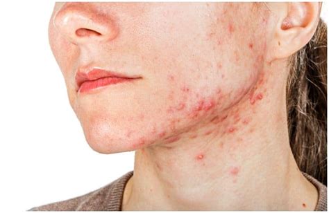 Nodular Acne Vs Cystic Acne Treatment Options And Differences