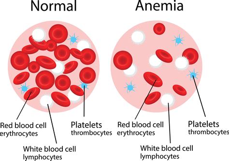 anemia  symptoms diagnosis treatments health daily advice