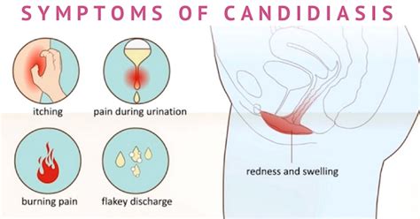 Candida Overgrowth Complete Guide On Treating A Candida Infection
