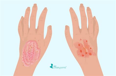 eczema  psoriasis whats  difference