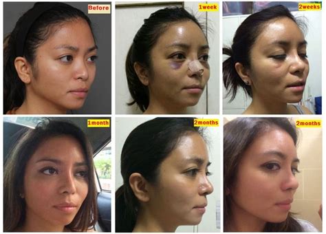 asian plastic surgery nose surgery and rhinoplasty on pinterest