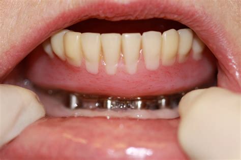 dental implants  save costs improve quality  life