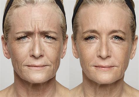 anti wrinkle injections brunswick melbourne  surgical face lift