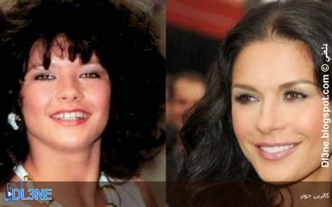 13 صورة تفضح أسنان مشاهير العالم قبل وبعد عمليات التجميل
