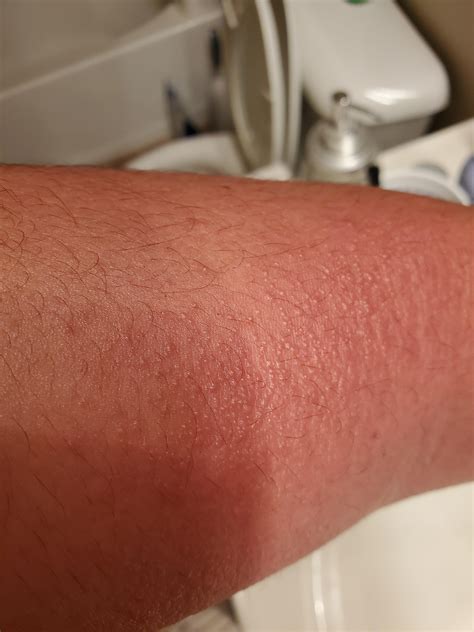 red skin rash  arm