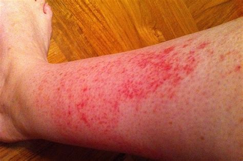 Red Rash On Legs Dorothee Padraig South West Skin Health