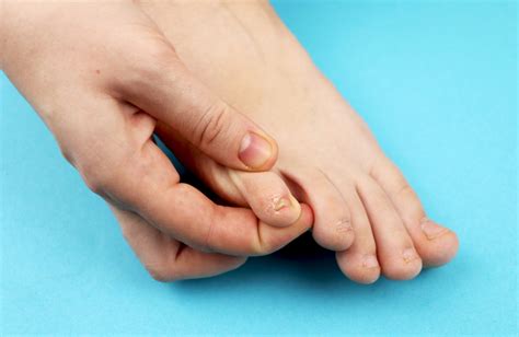 small pinky toenail problems  guide    treatments