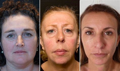 one of these 50 year old women has had filler for ten years another