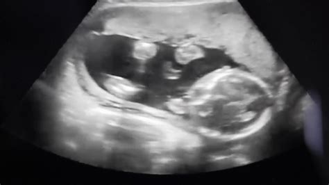 babys ultrasound  mothers womb stock footage sbv  storyblocks