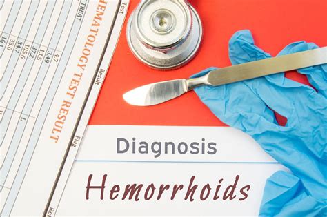 leczenie hemoroidów jak skutecznie wyleczyć hemoroidy