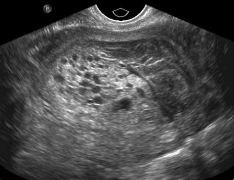 Transvaginal Ultrasound Examination Of Pelvic Organs A Sagittal View