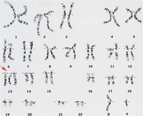 Trisomy 13 08 07 Trisomy 13