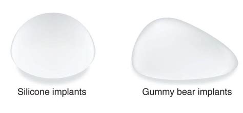 gummy bear implants plicker guide health news faq