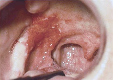 screening for and diagnosis of oral premalignant lesions