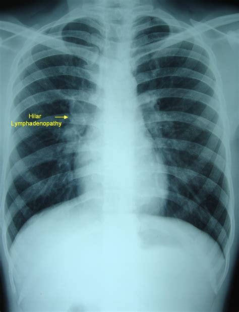 Hilar Lymphadenopathy On Chest X Ray