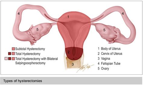 hysterectomy surgery uterus surgery frisco dallas