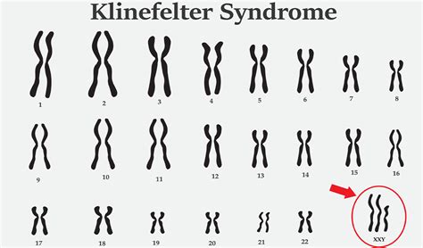 Klinefelter Syndrome – The Social Press