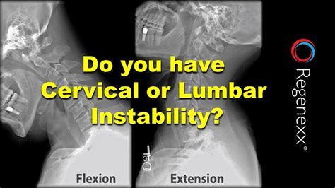 what is a flexion extension x ray regenexx®