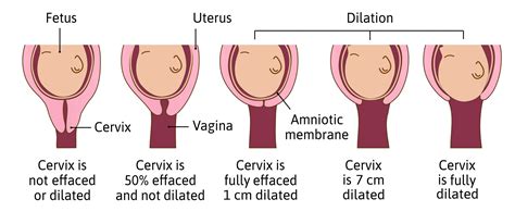 dilation  pregnancy american pregnancy association