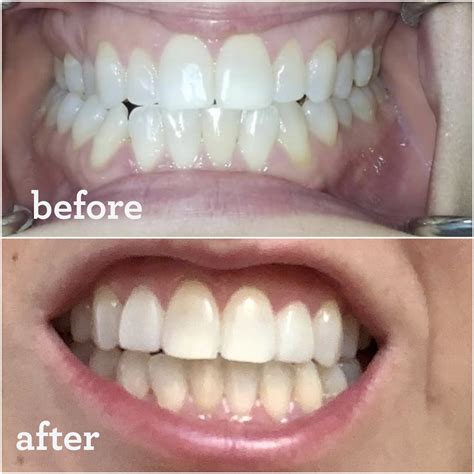 inspiralized  invisalign experience correcting  crossbite  crowding