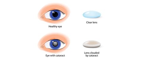 Explain Different Types Of Cataract Surgery