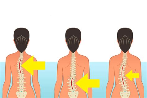 avoid   common activities   damage  spine factspedia