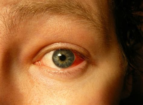 pink eye  symptoms treatment pictures     pink