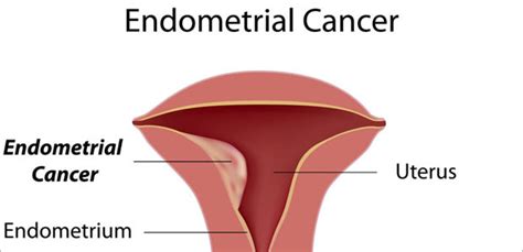 Uterine Cancer Symptoms After Menopause Cancerwalls
