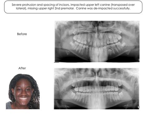 impacted blocked teeth orthodontic treatment photos