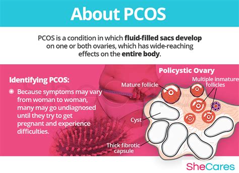 pcos polycystic ovary syndrome shecares
