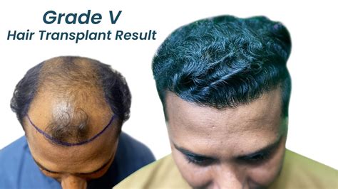 grafts hair transplant hair transplant results youtube