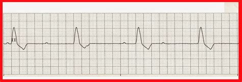 float nurse practice ekg rhythm strips